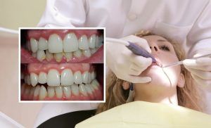 Remove Tartar And Plaque From Your Teeth